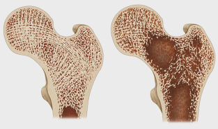 Osteoporose, Knochendichte